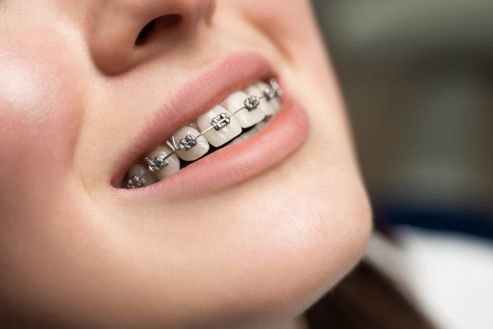 Types Of Braces Bellevue Orthodontics Smile Design Bellevue Wa